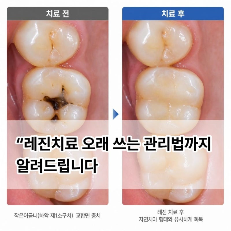 레진치료 오래 쓰는 관리법까지 알려드립니다.