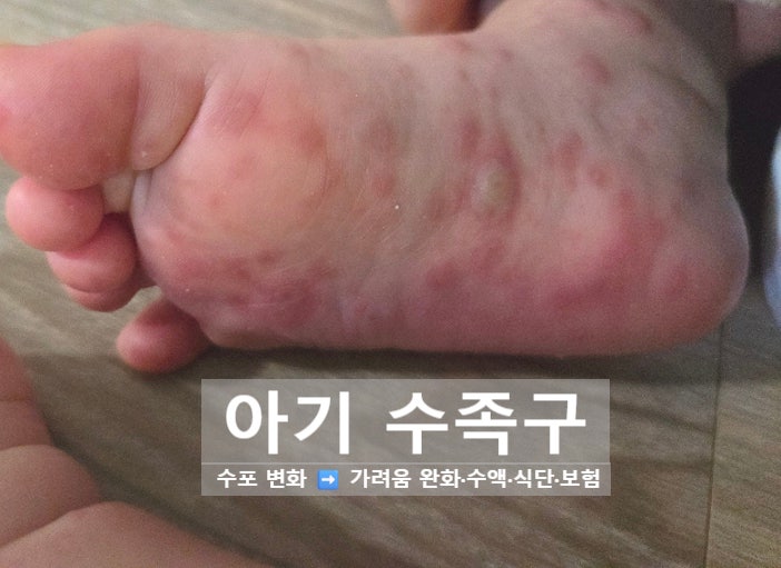 아기 수족구 초기증상·잠복기부터 수포 변화까지! 가려움 완화 팁·식단·보험 총정리