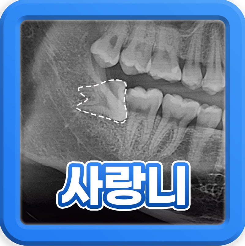사랑니 통증 있을 때 타이레놀 먹어도 되나요?