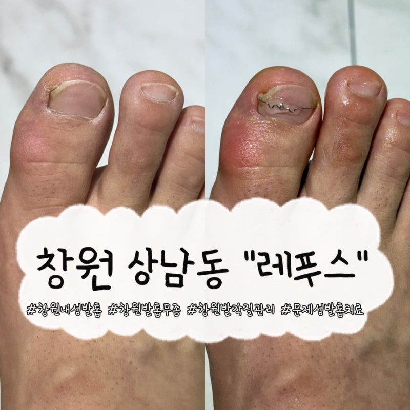 창원내성발톱 관리는 레푸스 창원상남점