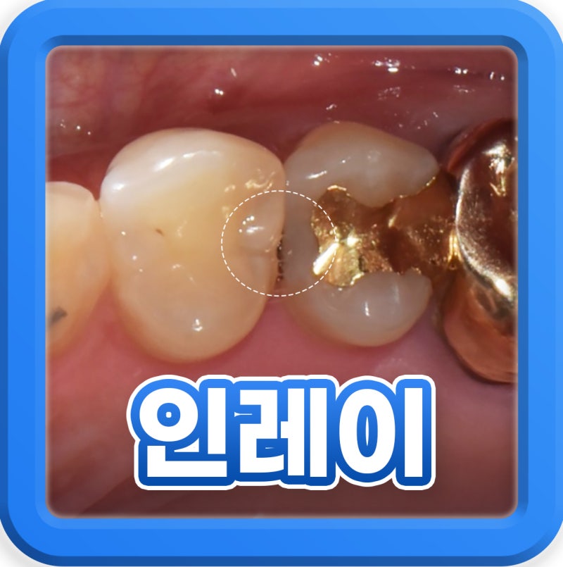 인레이 후 씹을 때 통증, 이 시림 원인 재치료해야하나요?