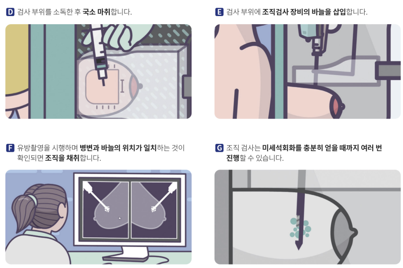 H대병원 유방미세석회 스테레오탁틱 조직생검술 검사후기