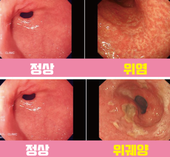 갑작스런 명치통증 속쓰림 원인 위궤양 증상 치료 위궤양약 한번에 알아보자