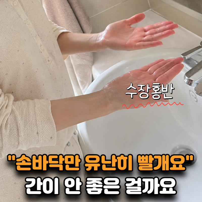 “손바닥만 유난히 빨개요” 수장홍반, 간이 안 좋다는 신호일까?