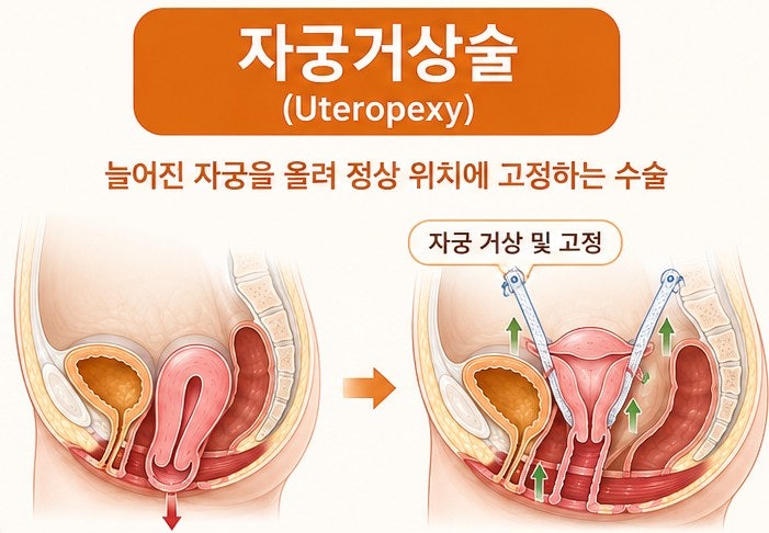자궁하수증 수술 시 자궁적출 필요할까? 자궁거상술 치료 가능한 경우(비용 및 보험과 요실....