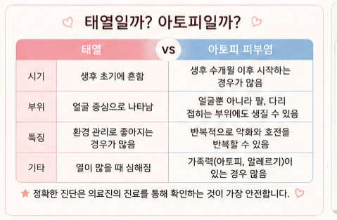 신생아 태열 언제까지? 원인부터 관리법 병원에 가야 하는 경우까지 총정리