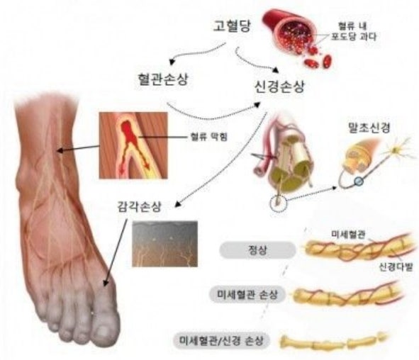 말초신경병증 증상 치료방법 확인