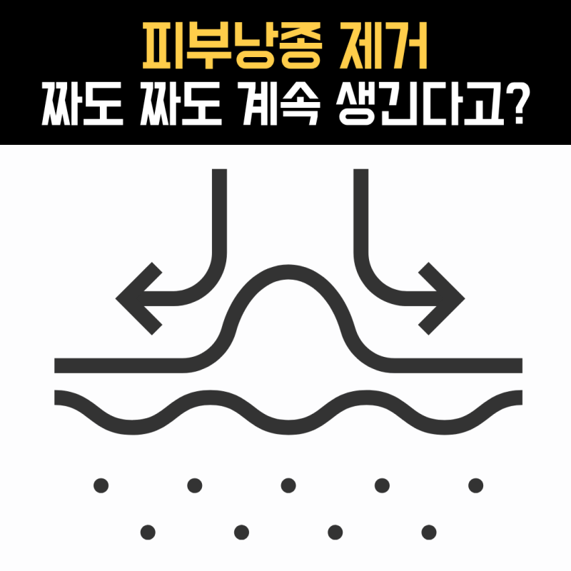 피지낭종 제거, 짜도 같은 자리에 다시 생기는 이유