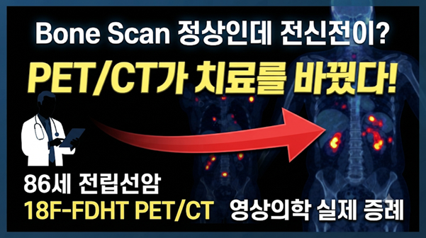 Case Study_1033-전립선암으로 황체호르몬 방출호르몬 작용제 치료를받고 있는 86세 남성-전립선....