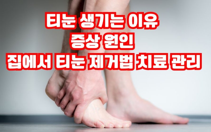 티눈 생기는 이유 증상 원인 집에서 티눈 제거법 치료 관리