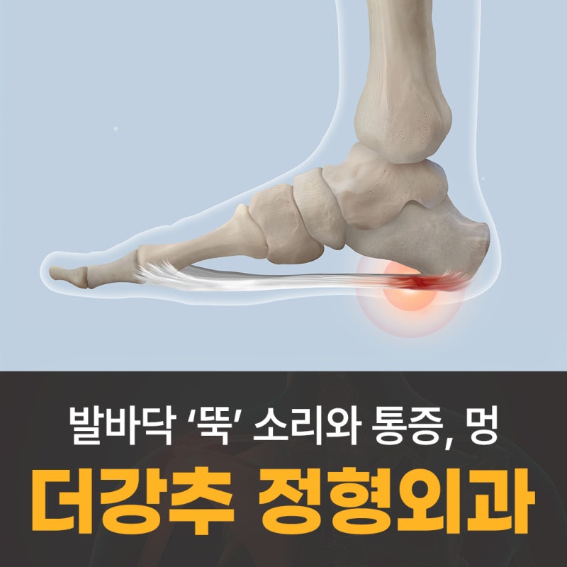 발바닥 ‘뚝’ 소리와 통증, 멍이 나타난다면? 족저근막 파열
