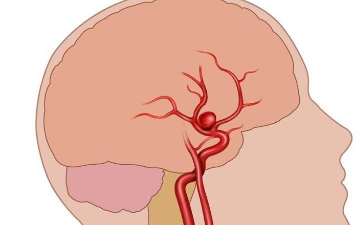 머리 혈관에 꽈리가 있다? 뇌동맥류?