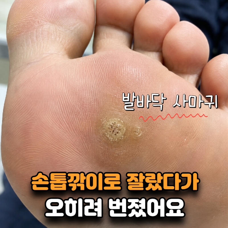 “옆에 하나 더 생겼어요” 발바닥 사마귀를 깎으면 안 되는 이유
