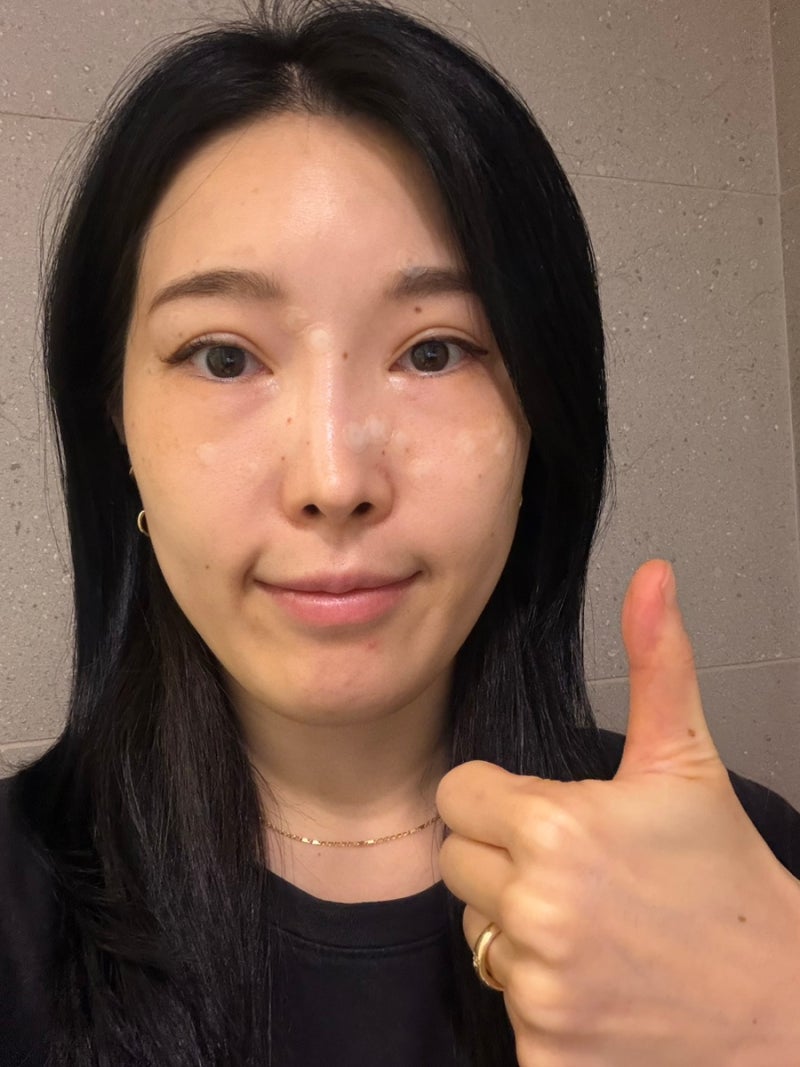 서울대입구역 비립종 제거 후기, 스레드 보고 다녀온 개당 1,100원 내돈내산 (CO2 레이저)