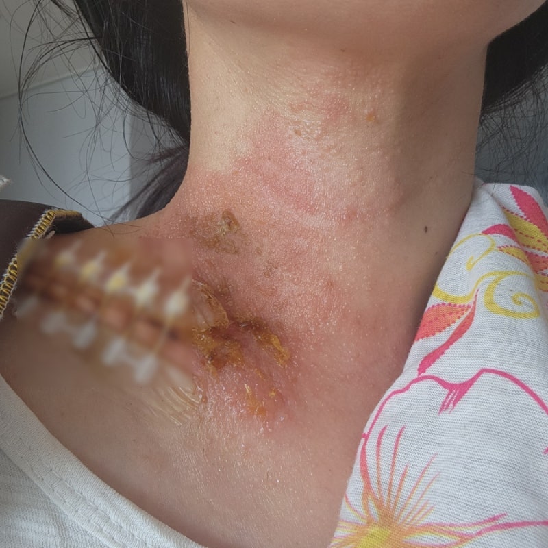 [맛냥 약사] 혐짤주의! 아토피 켈로이드성 피부 환자의 수술 상처 극복 기록 ㅠㅠ 밴드 접착....