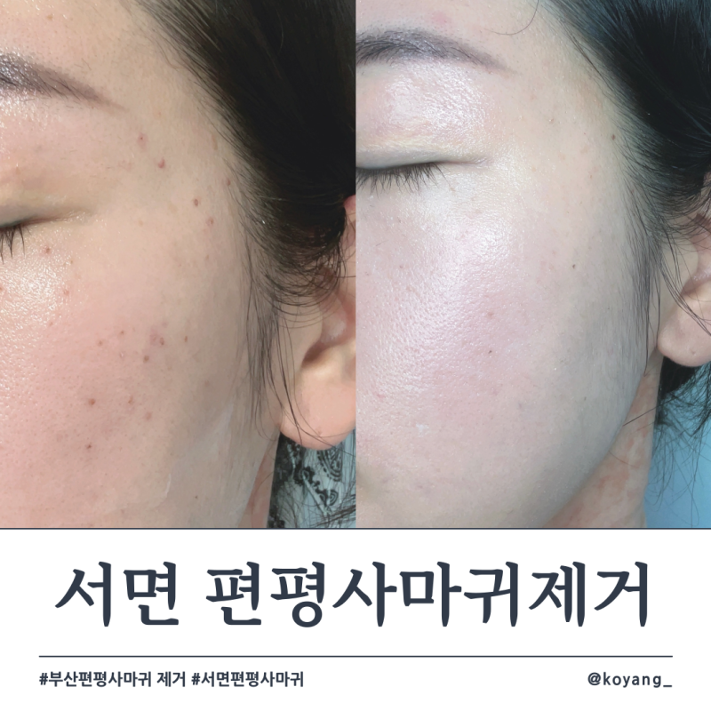 서면 편평사마귀 얼굴 전체 제거 일주일차 회복과정 솔직후기