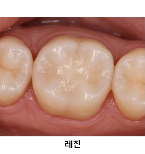 #레진 #인레이 #크라운 차이 총정리｜충치 치료 어떻게 선택할까? - #홍대치과 #홍대치아교정 ....