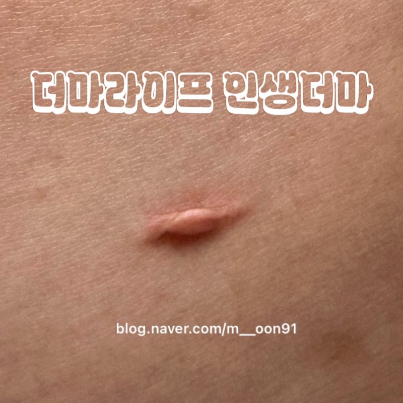 더마라이프 인생더마 (두달사용 솔직후기, 켈로이드상처 켈로이드피부 더마틱스울트라와 비....