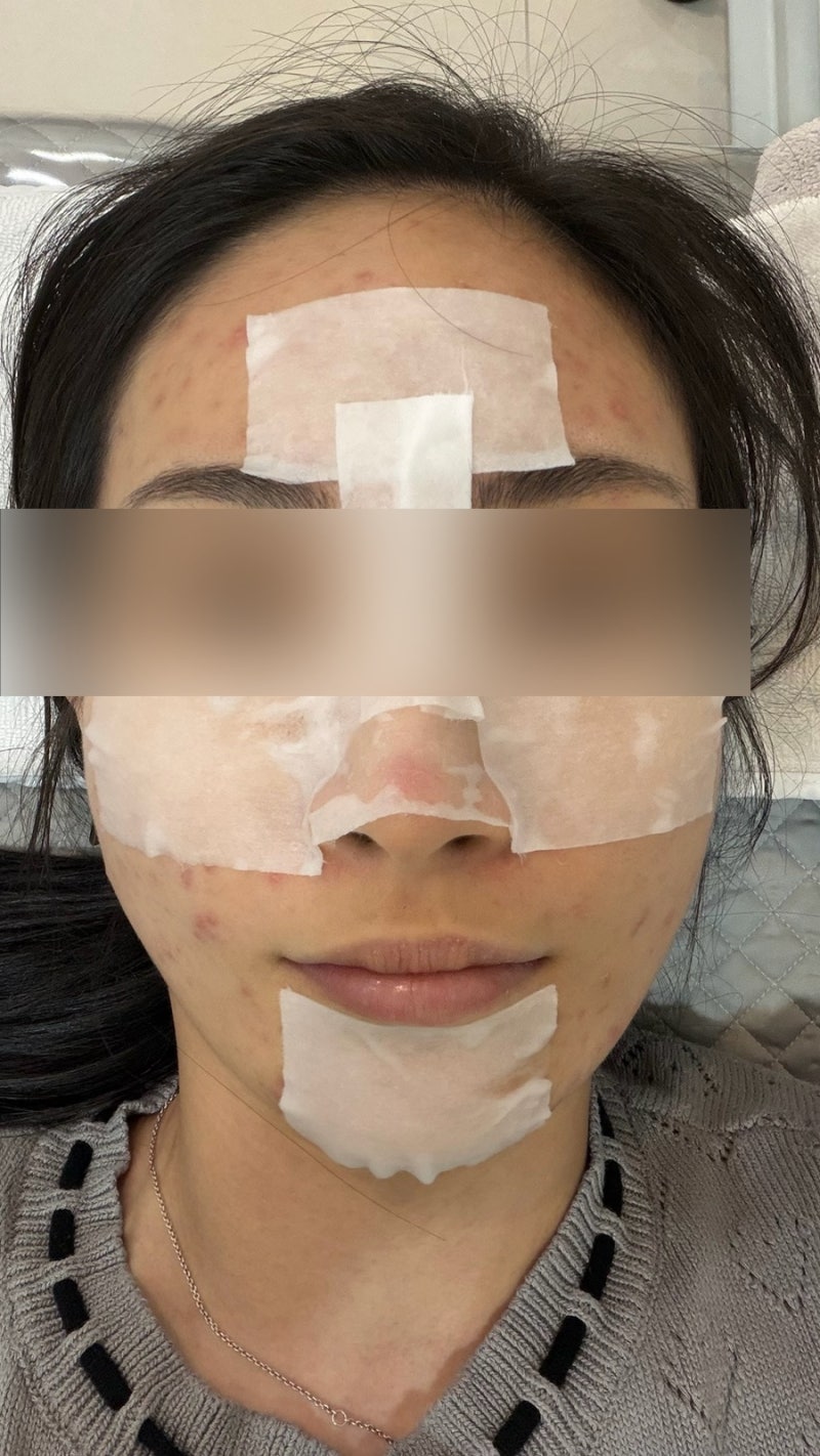 성인여드름 얼굴 이마 모낭염 극복기 모낭염 14탄- 아젤리아 크림 2주차 후기 , 아쿠아필 그리....