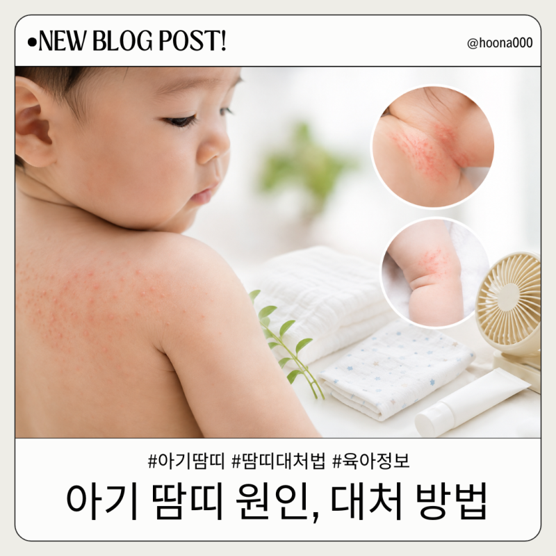 아기 땀띠 원인부터 관리법까지, 여름철 피부 지키는 방법