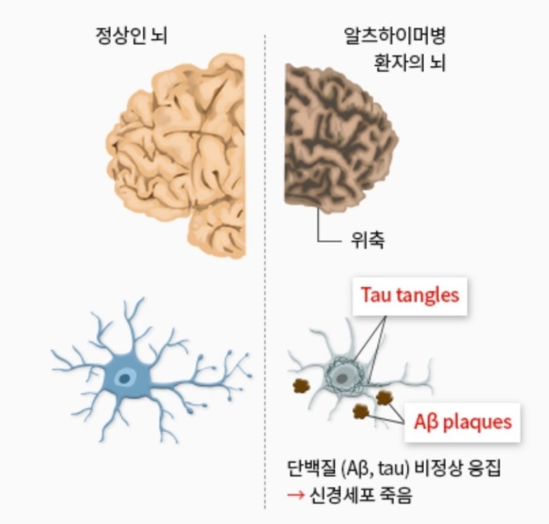 알츠하이머 치료제 시대 열렸다…치매 예방보다 중요한 ‘조기 진단’ 이유