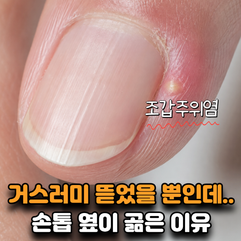 “거스러미 하나 뜯었을 뿐인데…” 손톱 옆이 곪은 이유
