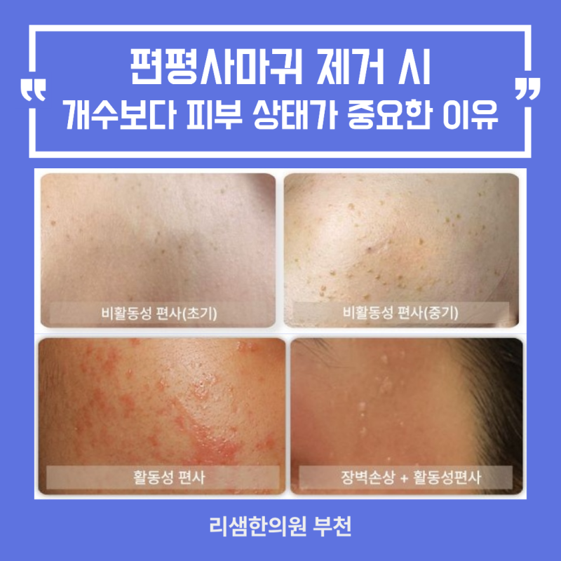 부천 편평사마귀 제거 무제한, 개수보다 피부 상태가 중요한 이유