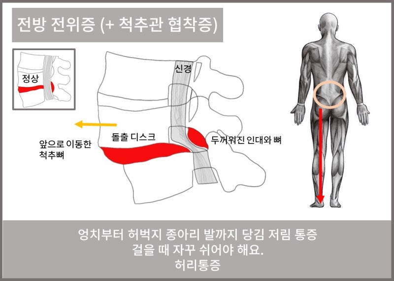 척추전방전위증