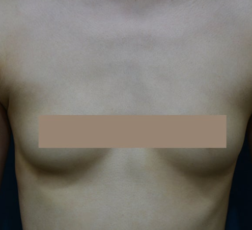 가슴필러, 가슴성형 대신 선택할 수 있을까? 효과와 위험성 정리