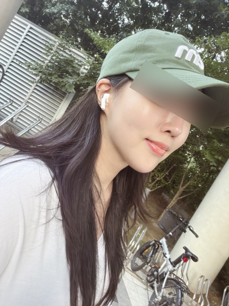 사각턱보톡스 침샘보톡스 리터치 전후 효과 비교 후기