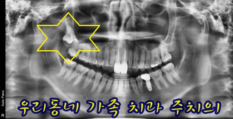 대학병원 가야 한다던 매복 사랑니, 인천 부평 구강외과 전문의 당일 발치 실제 증례