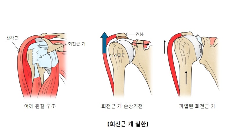 회전근개파열 수술비, 내 보험에서 얼마나 보장될까?