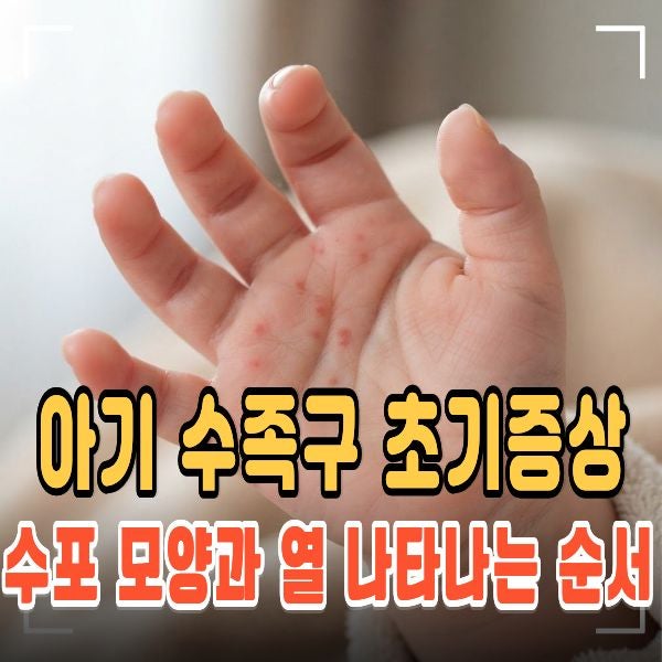 아기 수족구 초기증상 5가지! 수포 모양과 열 나타나는 순서