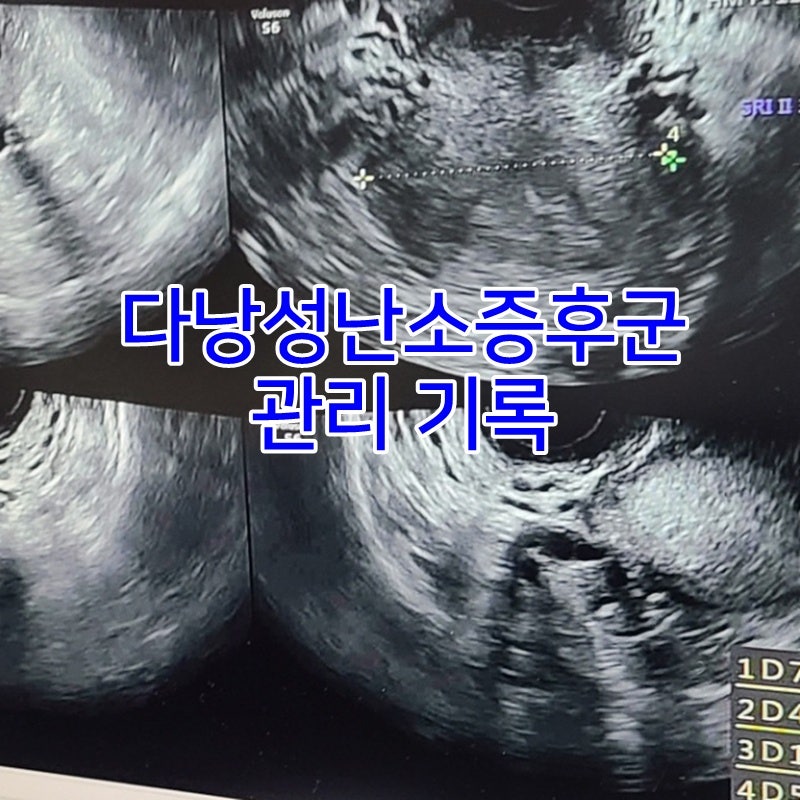 다낭성난소증후군 비만 원리분석후 -4kg