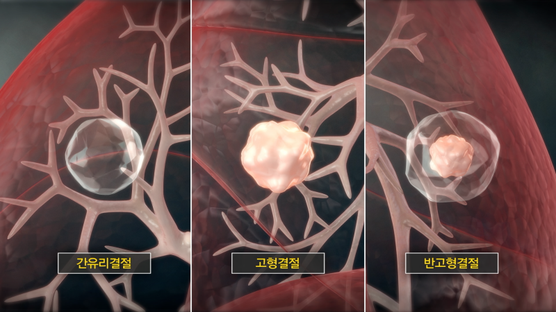 [EBS 명의] 폐결절, 암일까 아닐까? 간유리결절부터 폐암까지 알아봅니다