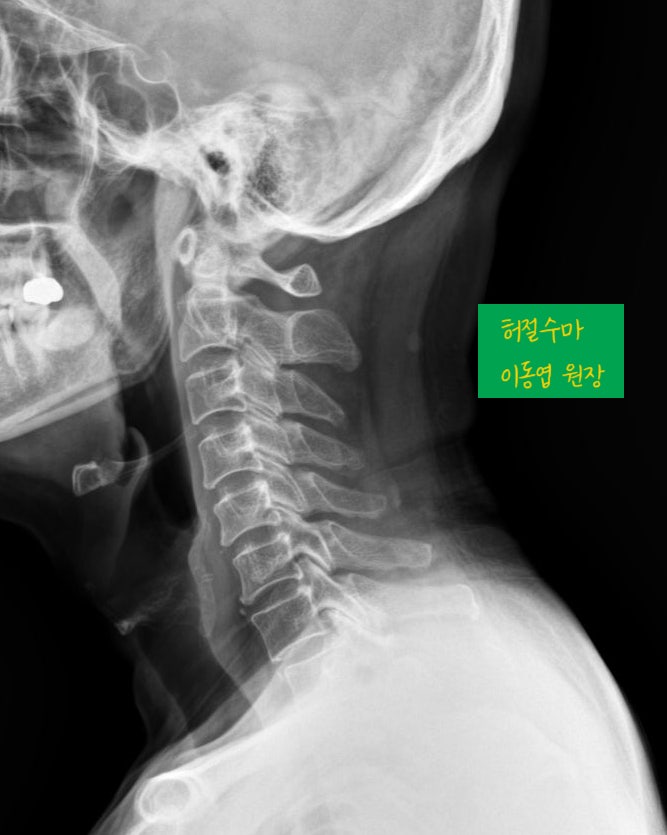 경추6-7번 급성 목디스크 탈출 돌출 파열, 가장 좋은 자세는?