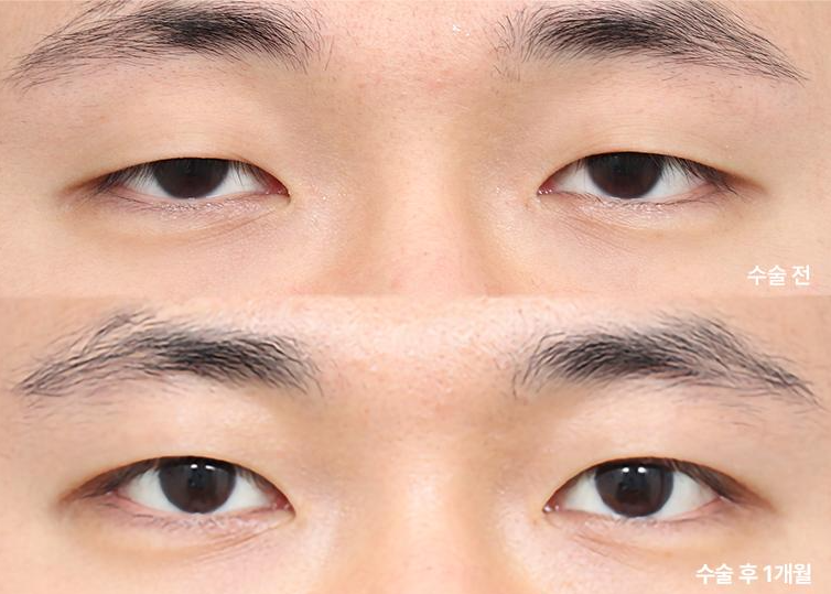 [성형 정보] 티 안 나게 또렷해지는 법! 무쌍 눈매교정 vs 쌍꺼풀 수술 차이 및 회복 기간
