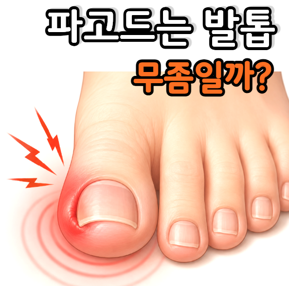 발톱건강|파고드는 엄지발톱, 무좀일까요?차이와 확인 방법