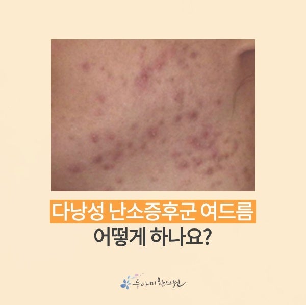 다낭성난소증후군 여드름, 턱•목 낭종성 여드름으로 심해지는 이유와 야즈의 연관성