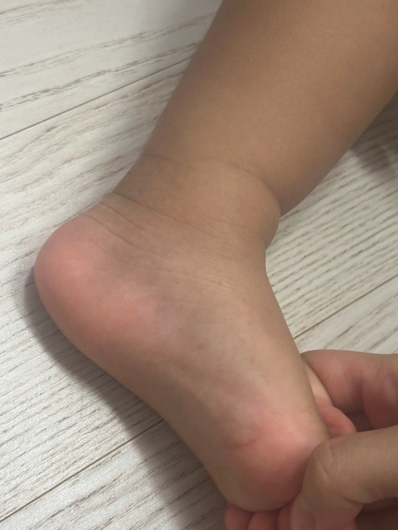 아기 수족구 증상부터 입원비용 및 보험 청구 기록(17개월아기)