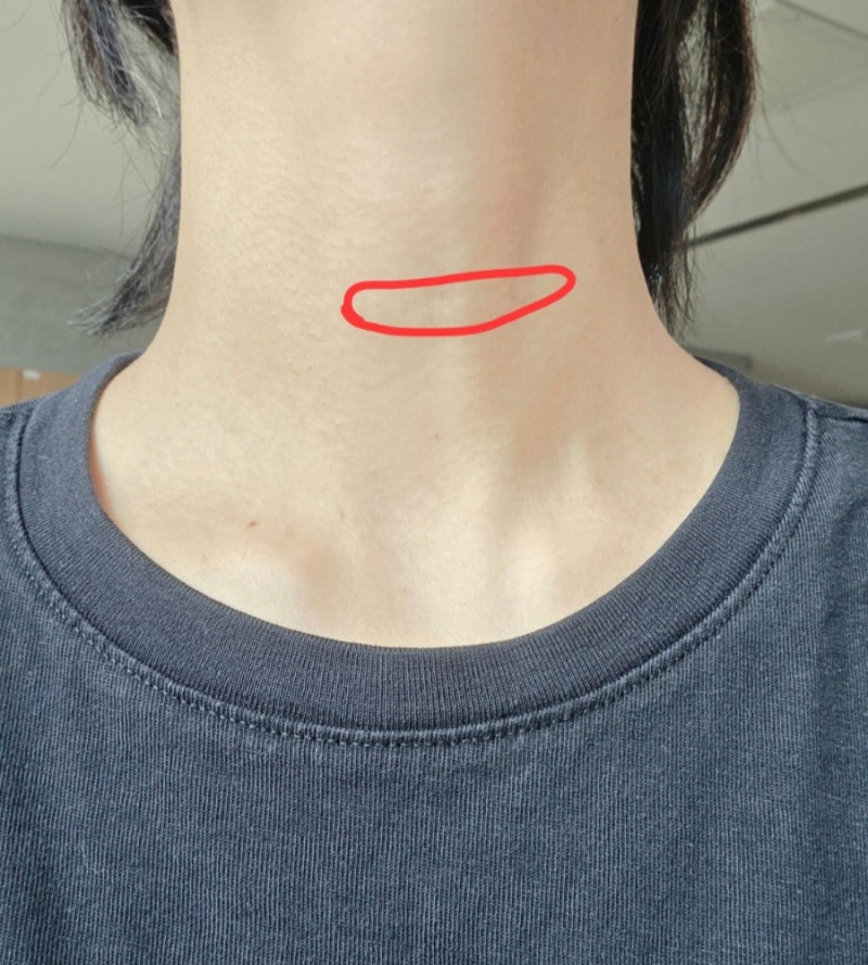 리뷰 | 갑상선 유두암 반절제 수술 후 1년 : 흉터 변화 기록, 호르몬 수치 관리