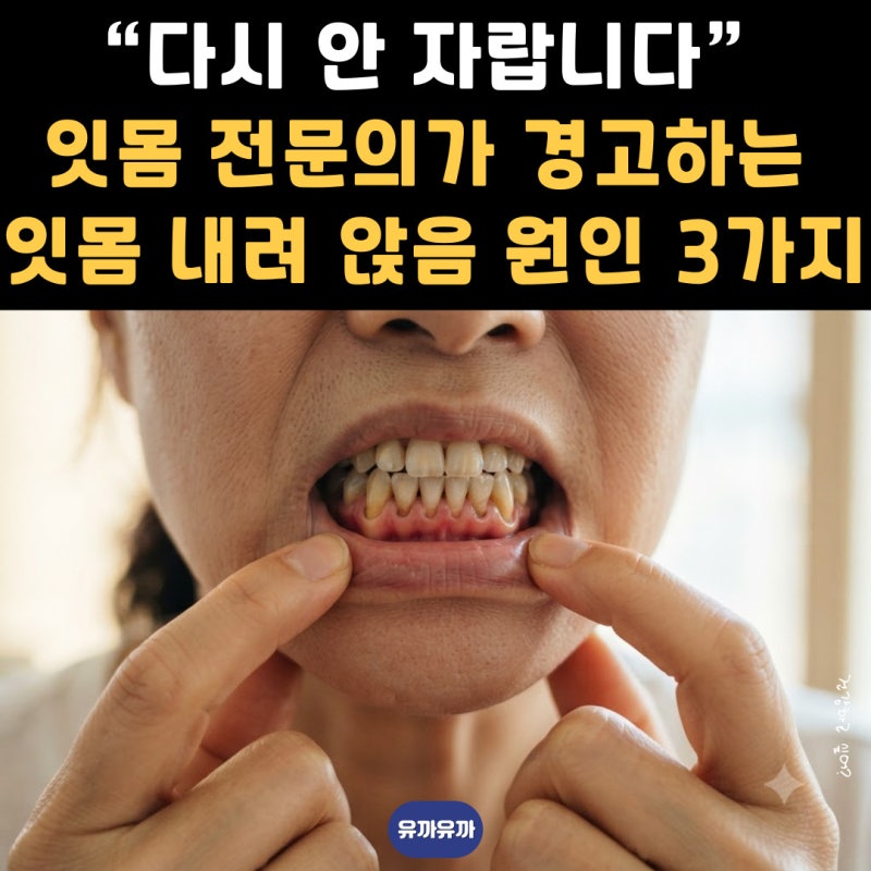 “다시 안 자랍니다” 잇몸 전문의가 경고하는 잇몸 내려 앉음 원인과 회복법