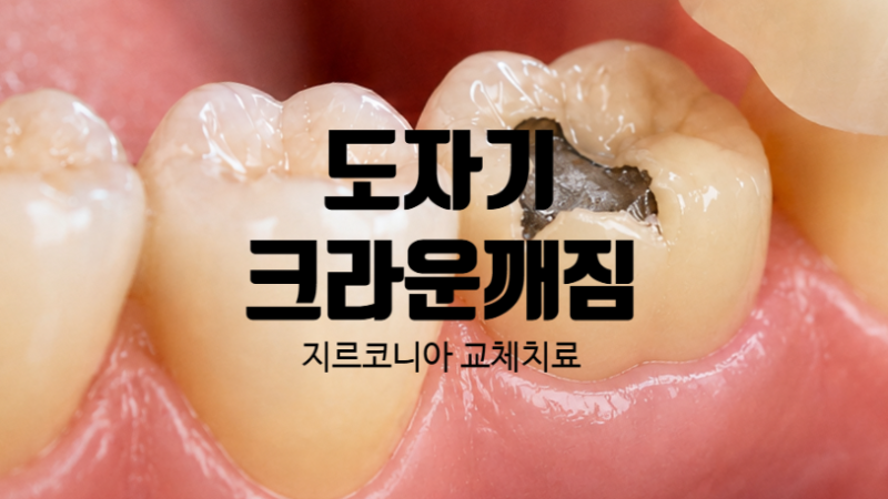 어금니 크라운 깨짐, 지르코니아로 치료 시청 치과