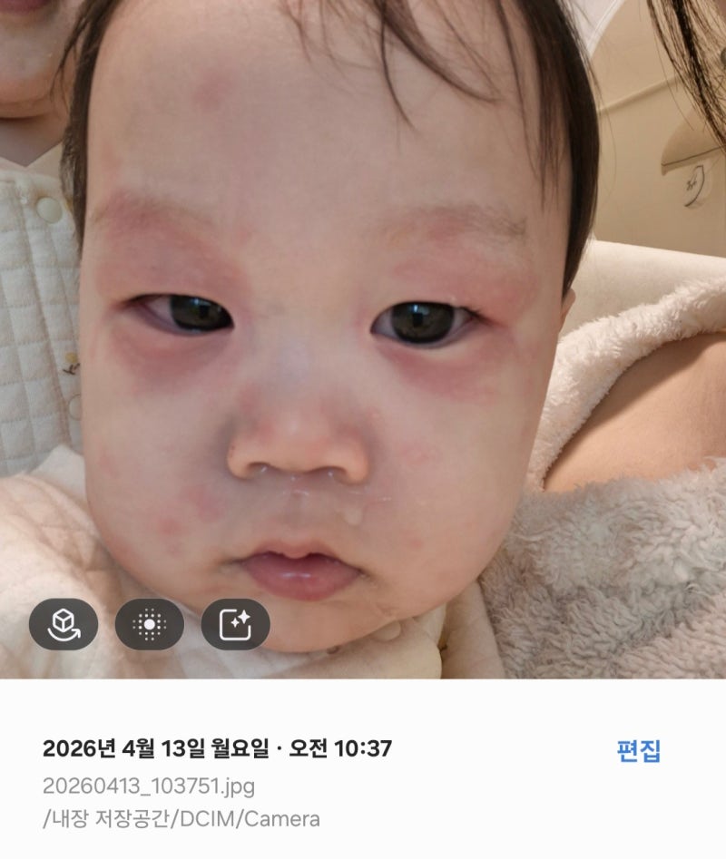 경험담 공유) 아기 계란 알러지 증상 / 대처 방법/ 테스트 방법