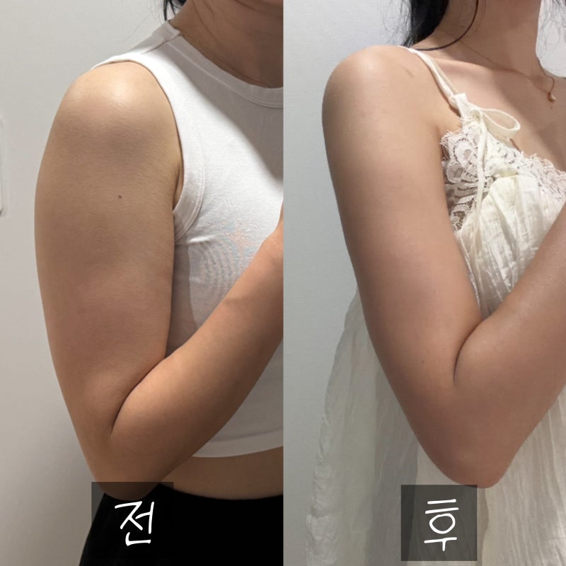 구미 팔뚝 지방추출주사 가격, 라인 변화