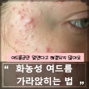 화농성 여드름 빨리 가라앉히는 법｜원인·여드름균·짜기 전 관리