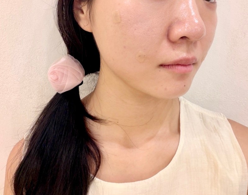 상계역피부과 나비존 모공 모공부스터 후기 3회차