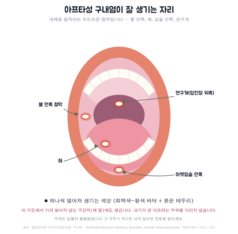 입안이 헐었어요 — 아프타성 구내염, 원인과 약 이야기