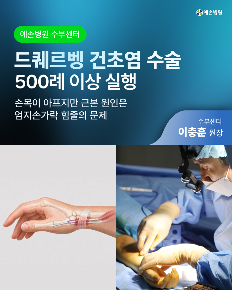 예손병원, 드퀘르벵 건초염 수술 500례 이상 실행... 손목이 아프지만 근본 원인은 엄지손가락....