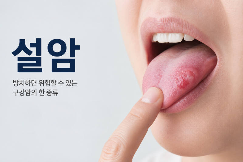 혀 상처가 2주이상 안낫고 혀에 멍울이 만져져요, 설암 증상과 원인 구내염과의 차이점 알아....